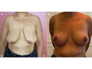 Mastopexie - Dr Laurent Benadiba