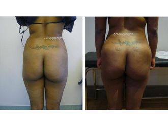 Lipofilling avant et après - 818903