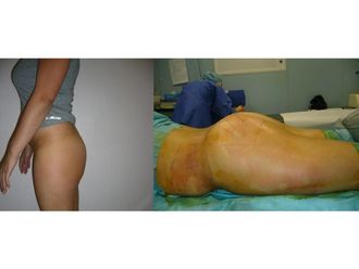 Lipofilling avant et après - 818904