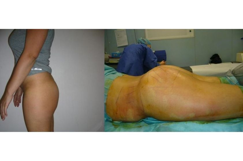 Lipofilling avant et après - 818904