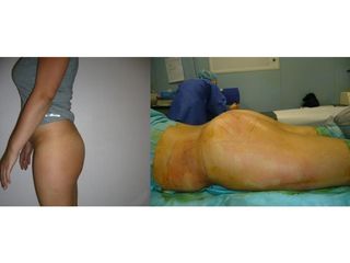 Lipofilling - Dr Laurent Benadiba