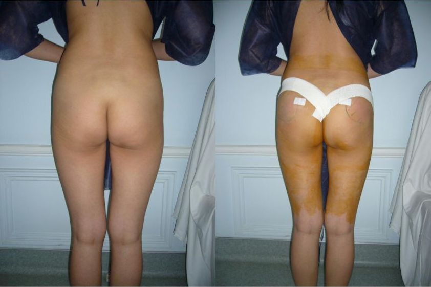 Lipofilling avant et après - 818905