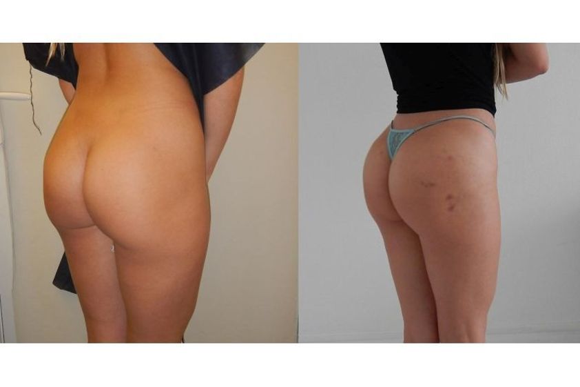 Lipofilling avant et après - 818907