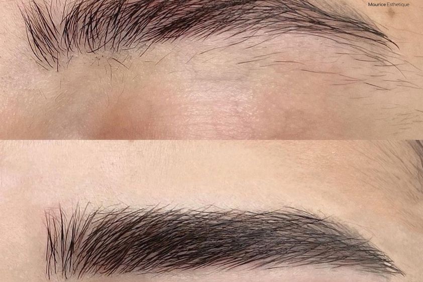 Dermopigmentation avant et après - 867542