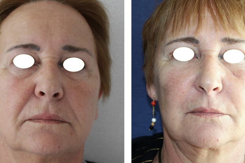 Lipofilling avant et après - 576199