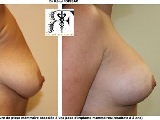 Implants mammaires avant et après - 576204