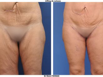 Bodylift avant et après - 576207