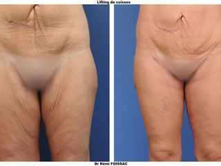 Avant après Lifting de cuisses