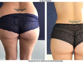 Avant après Liposuccion