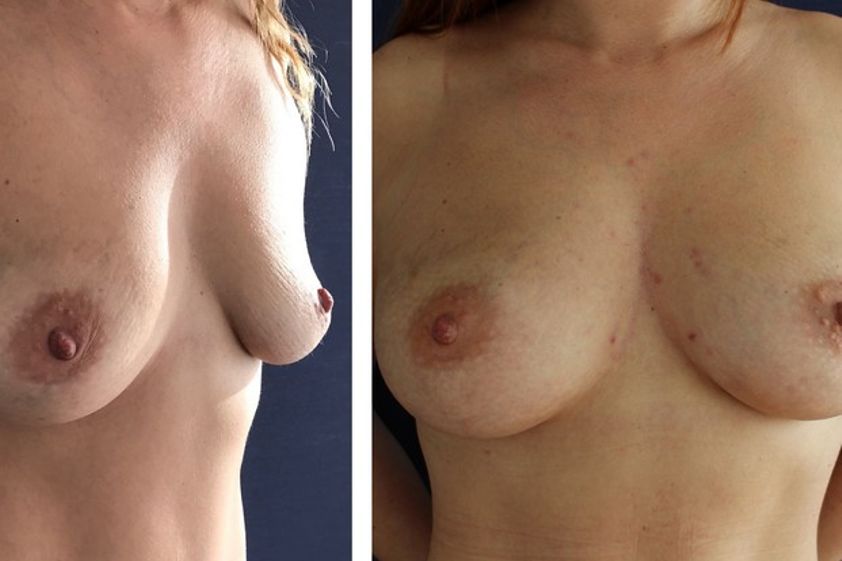 Lipofilling avant et après - 576210