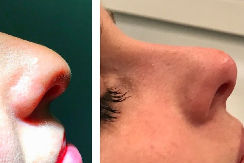 Rhinoplastie médicale avant et après - 576217