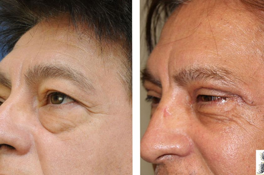 Blépharoplastie avant et après - 576219