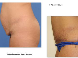 Avant après Abdominoplastie