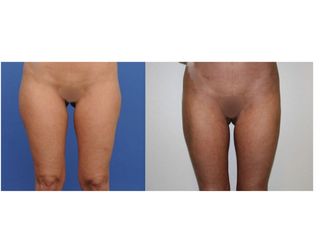 Avant après Liposuccion