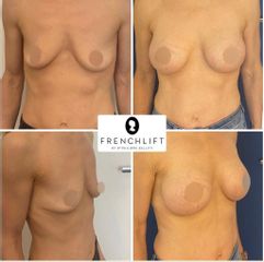 Augmentation mammaire - Dr Philippe Bellity