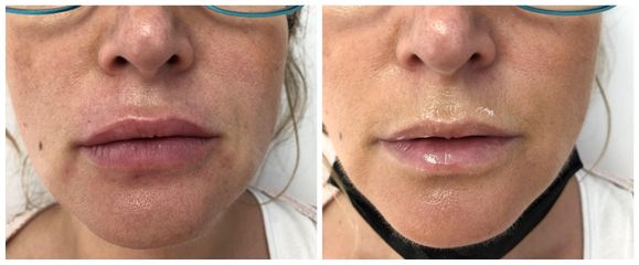 Augmentation des lèvres - Dr Véronique Guislain