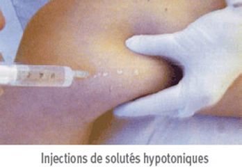 Injections lipolytiques anti-cellulite