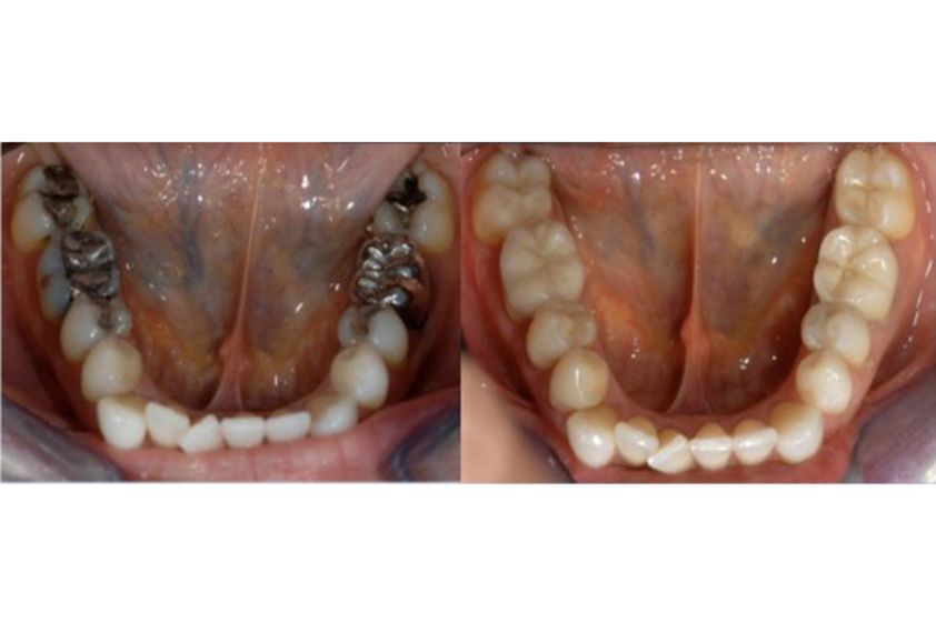 Blanchiment des dents avant et après - 543654