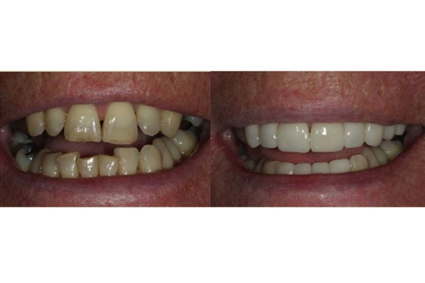 Blanchiment des dents avant et après - 543660
