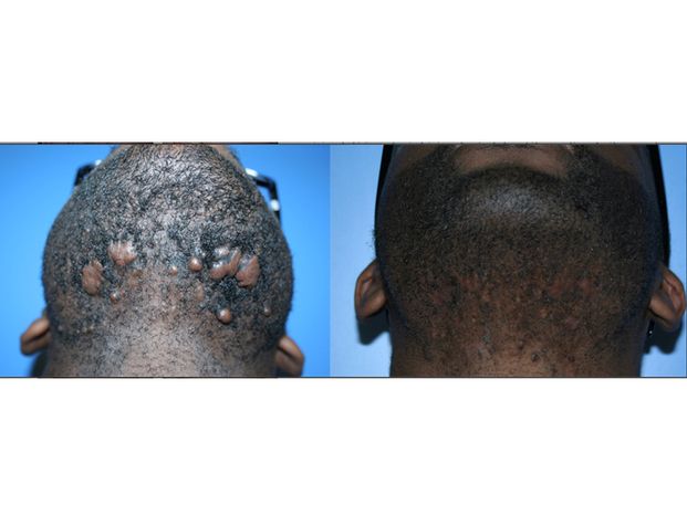 Chéloïde Avant et après Multiesthetique.fr Multiesthetique.fr