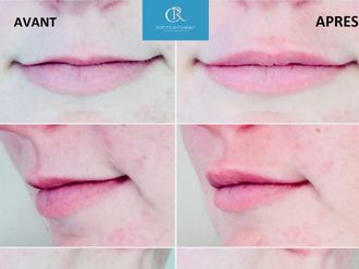 Augmentation des lèvres-611378