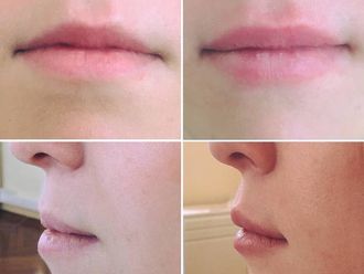 Augmentation des lèvres-611380