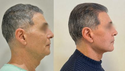 Lifting Pr Jean-Paul Meningaud