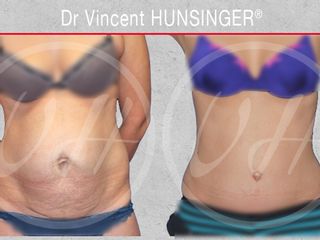 Avant après Abdominoplastie et diastasis