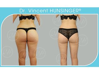 Avant après Liposuccion