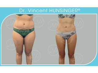 Avant après Liposuccion