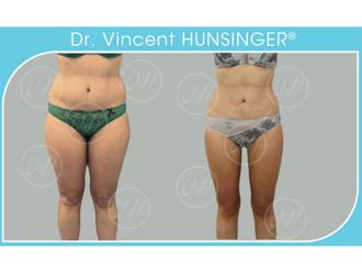 Liposuccion - 632091