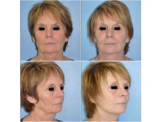 Avant après  Lifting cervico-facial 