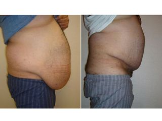 Avant après Lipoaspiration