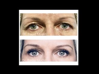 Blépharoplastie - 642705