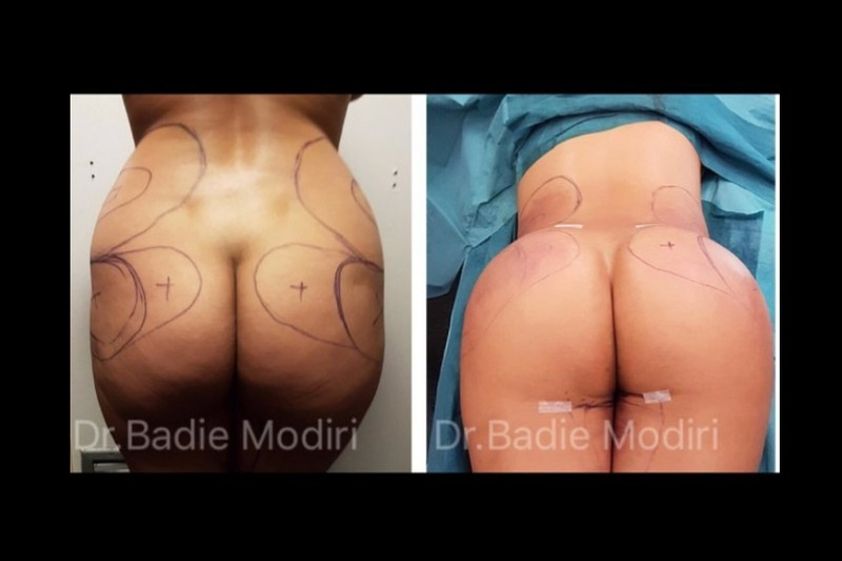 Chirurgie des fesses avant et après - 642708