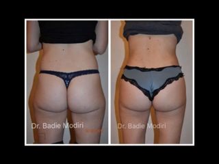 Avant après Liposuccion