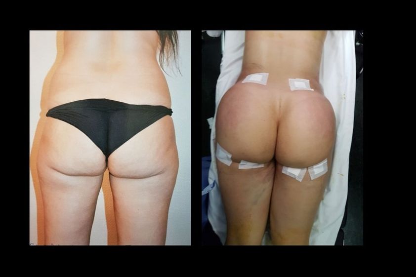 Lipofilling avant et après - 642712