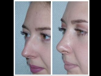 Rhinoplastie - 642714