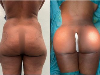 Chirurgie des fesses avant et après - 841853