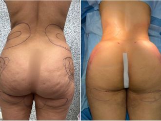 Chirurgie des fesses avant et après - 841854
