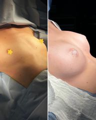 Augmentation mammaire - Dr Behzad Badie Modiri