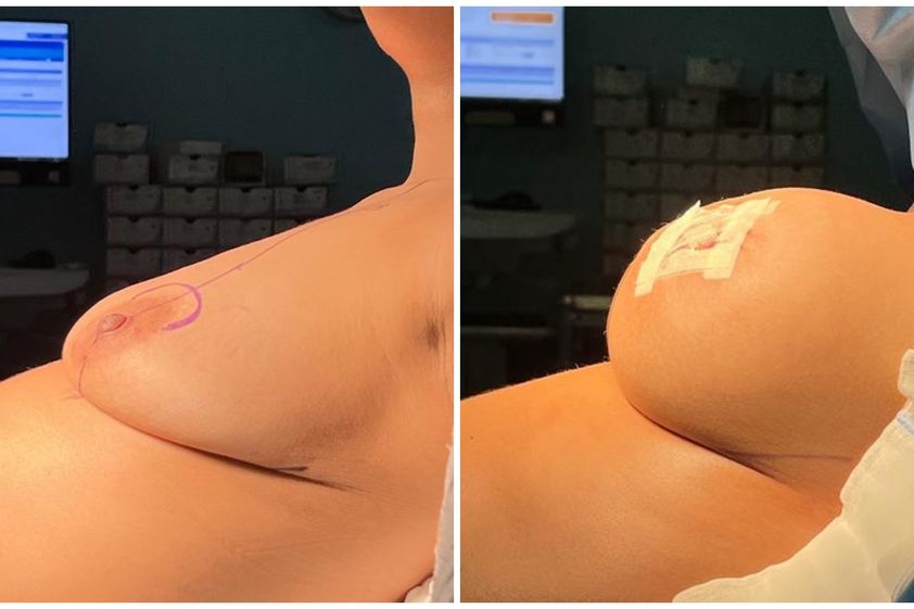 Augmentation mammaire avant et après - 850144