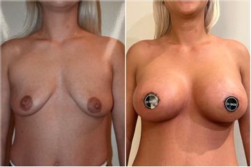 Augmentation mammaire - Dr Behzad Badie Modiri