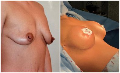 Augmentation mammaire - Dr Behzad Badie Modiri