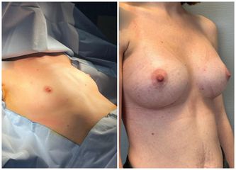 Augmentation mammaire - Dr Behzad Badie Modiri