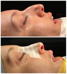 Rhinoplastie - Dr Behzad Badie Modiri