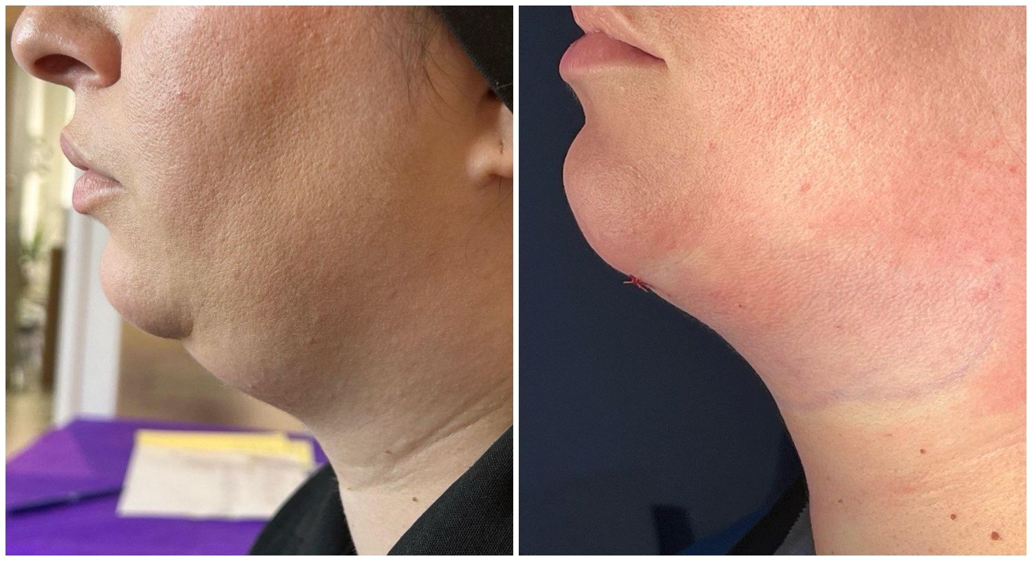 Liposuccion Avant et après Multiesthetique.fr Multiesthetique.fr