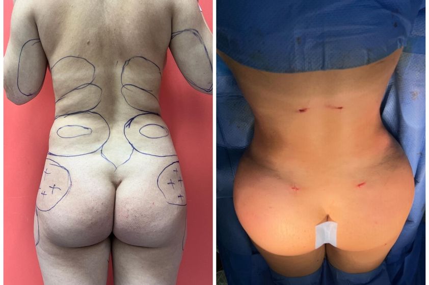 Liposuccion avant et après - 863638