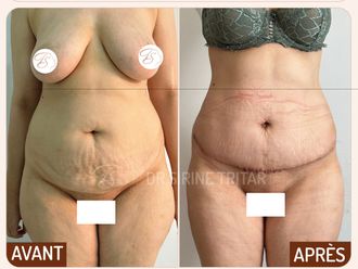 Abdominoplastie avant et après - 876600