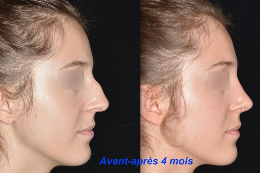 Rhinoplastie avant et après - 631989